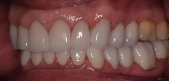 Patient smile after dental treatment, case 1