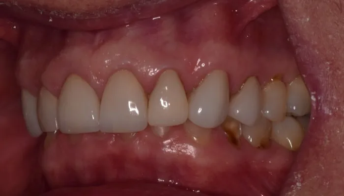 Patient smile before dental treatment, case 1
