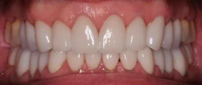 Patient smile after dental treatment, case 2