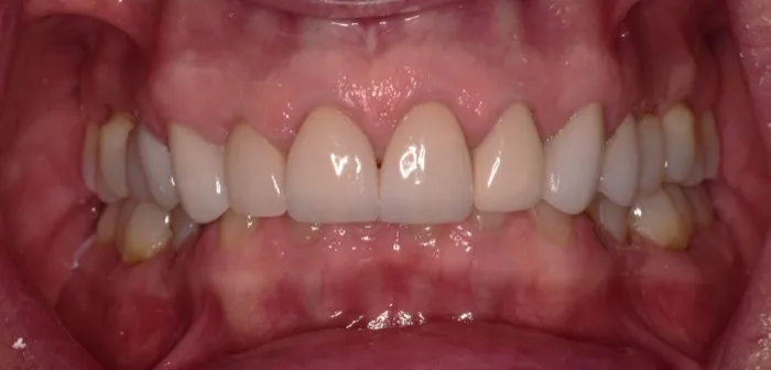 Patient smile before dental treatment, case 2