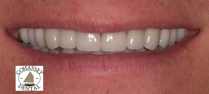 Patient smile after dental treatment, case 3