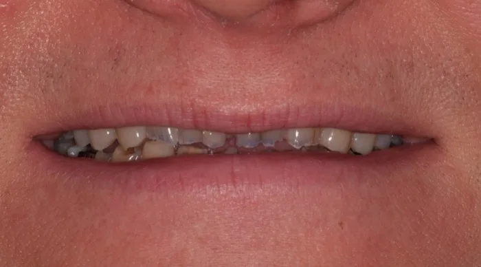 Patient smile before dental treatment, case 3