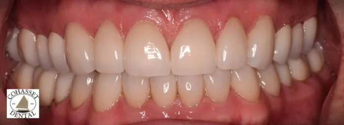 Patient smile after dental treatment, case 4
