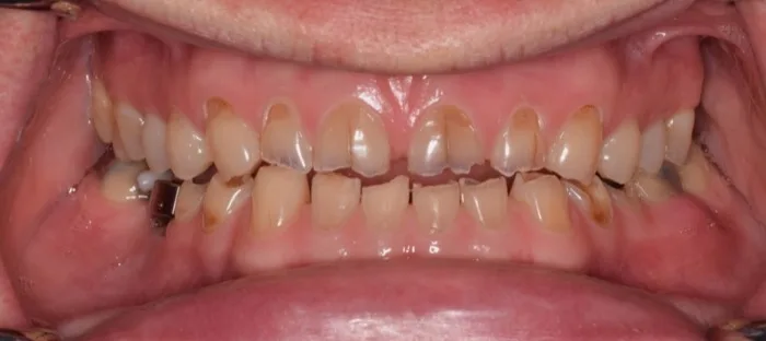 Patient smile before dental treatment, case 4